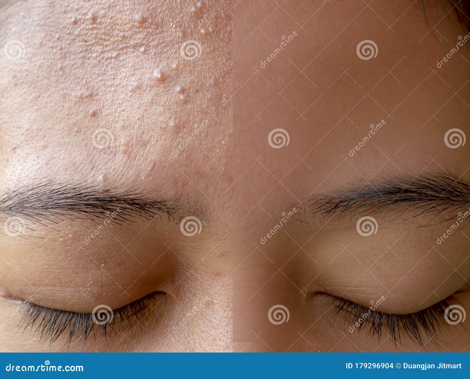 Before and after Acne Treatment Stock Photo - Image of care, body