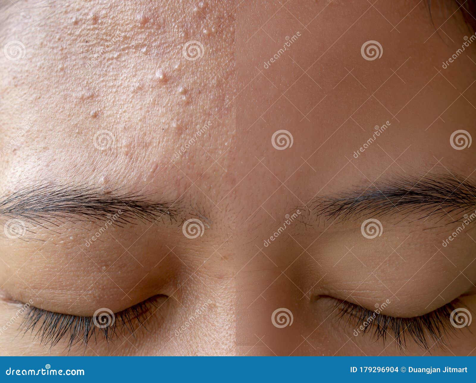 before and after acne treatment