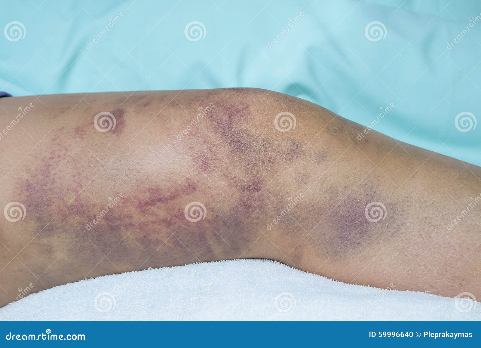 Closeup On A Bruise On Wounded Woman Leg Stock Photo Image Of Blow