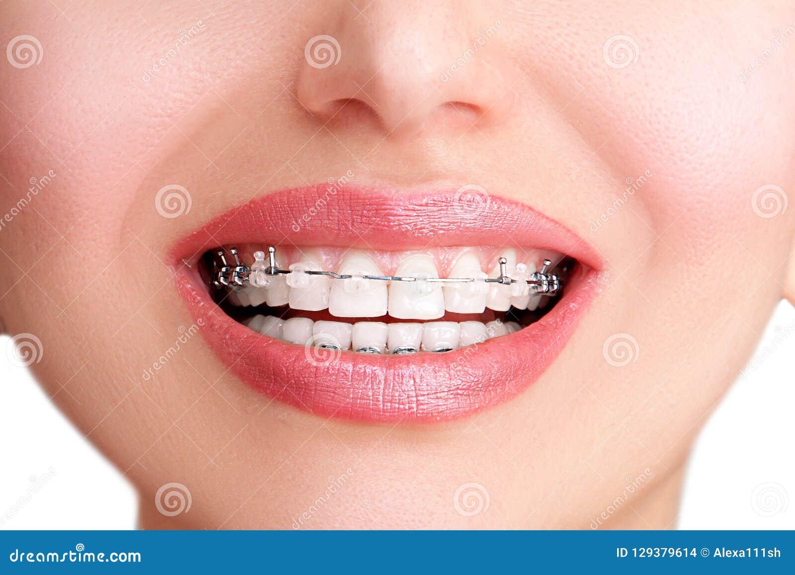 Closeup Ceramic And Metal Braces On Teeth Beautiful Female Smile With Self Ligating Braces 