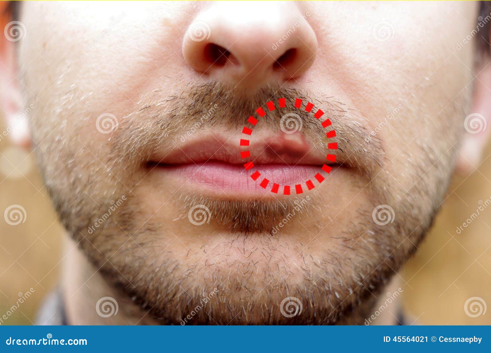 Closeup Of A Common Cold Sore Virus Herpes. Stock Image Image 45564021