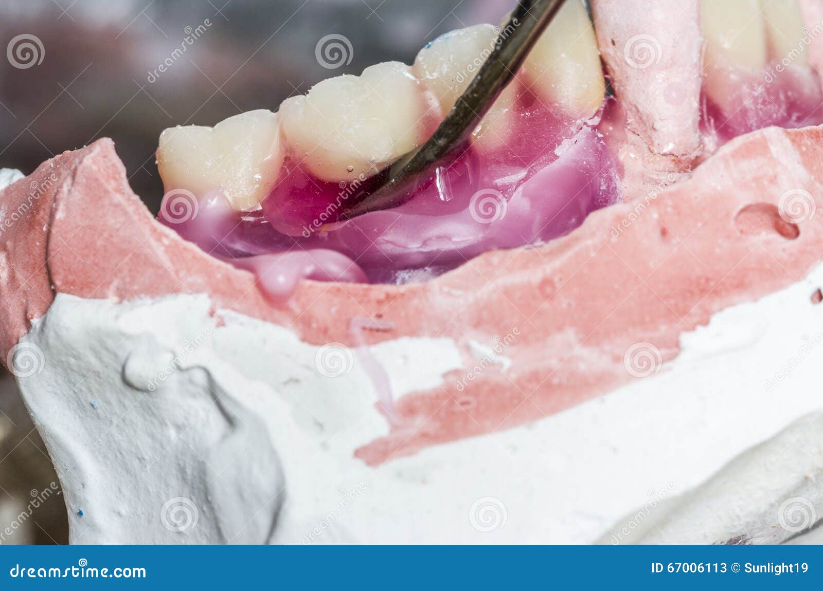 Closeup of Dental Technician is Working with Wax in Dental Mold Stock