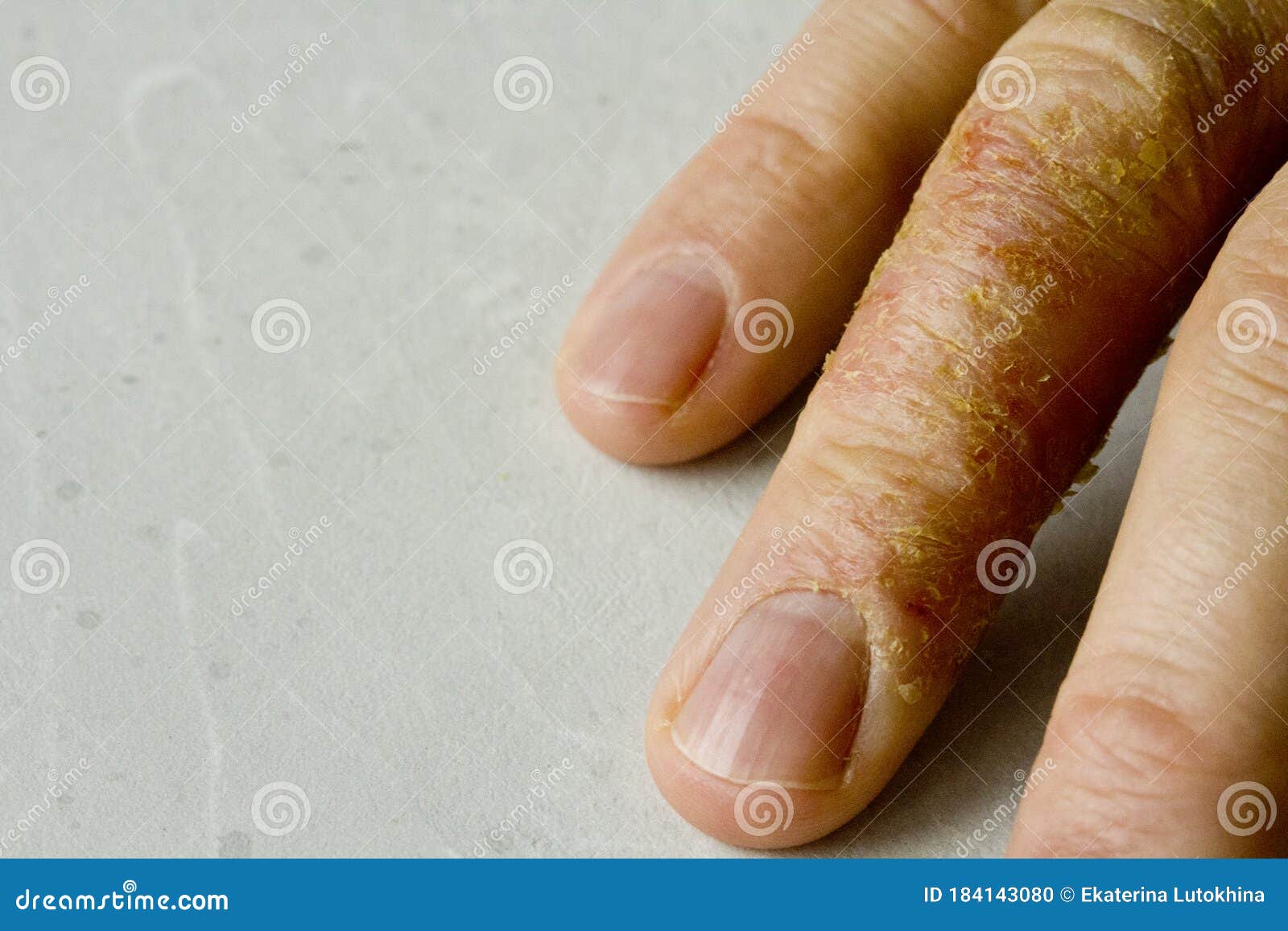 Closeup Of Eczema Dermatitis On Man Hand And Fingers Skin Peeling