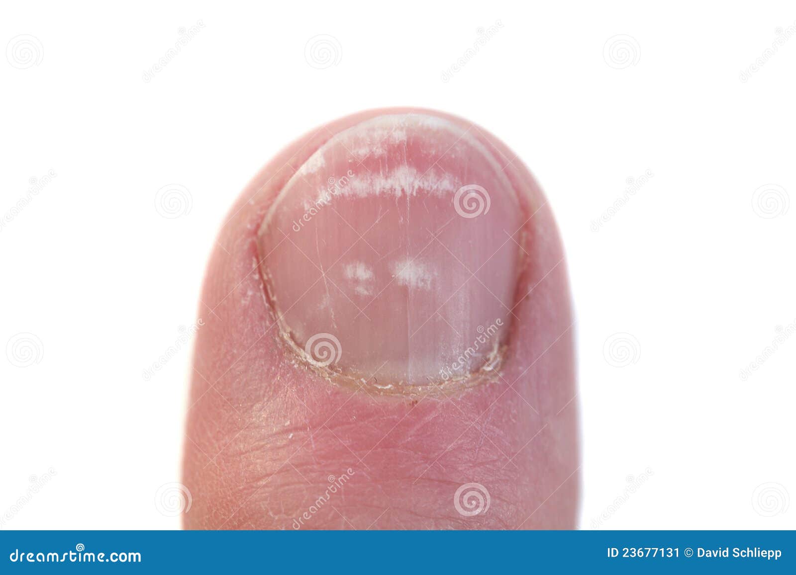 closeup of a fingernail with leukonychia