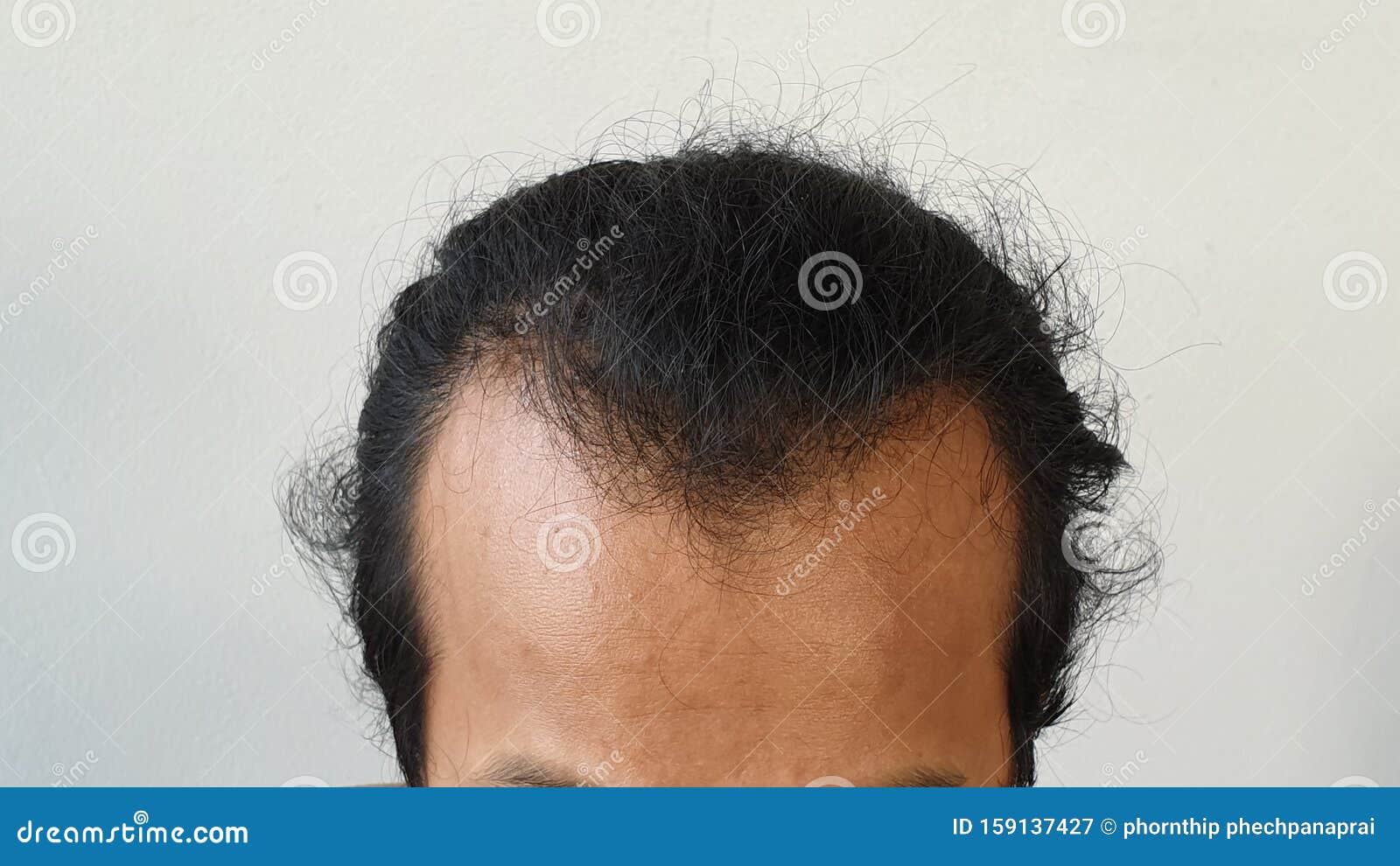 Closeup the Front of Head Lose Hair of Asian Man. Glabrous As V Shape Stock Image - Image of front, adult: 159137427 Closeup the Front of Head Lose Hair of Asian Man. Glabrous As V Shape Stock Image - Image of front, adult: 159137427