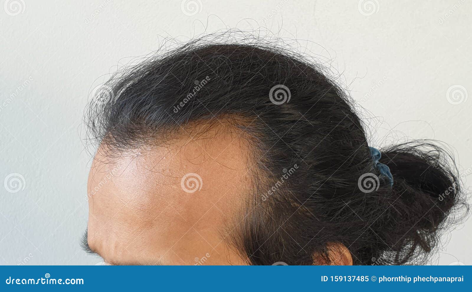 Closeup the beside of Head Lose Hair of Asian Man. Glabrous As V Shape  Stock Image - Image of baldness, brow: 159137485