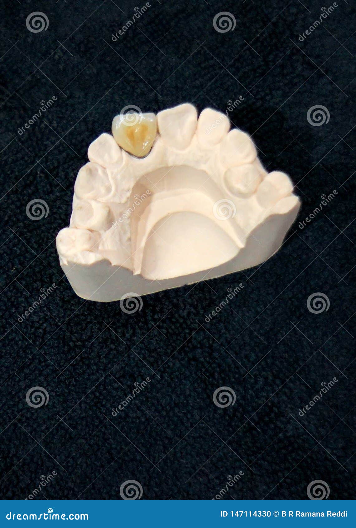 Closeup of Human Lower Jaw Denture Mold Stock Photo Image of