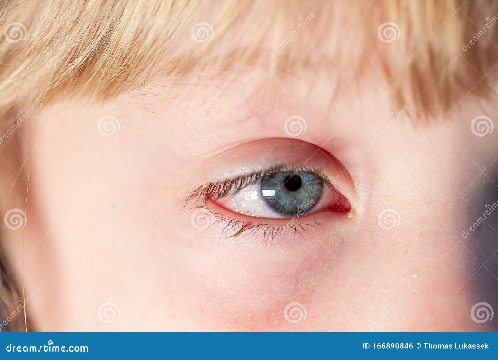Closeup of Irritated Red Bloodshot Eye Conjunctivitis Stock Photo