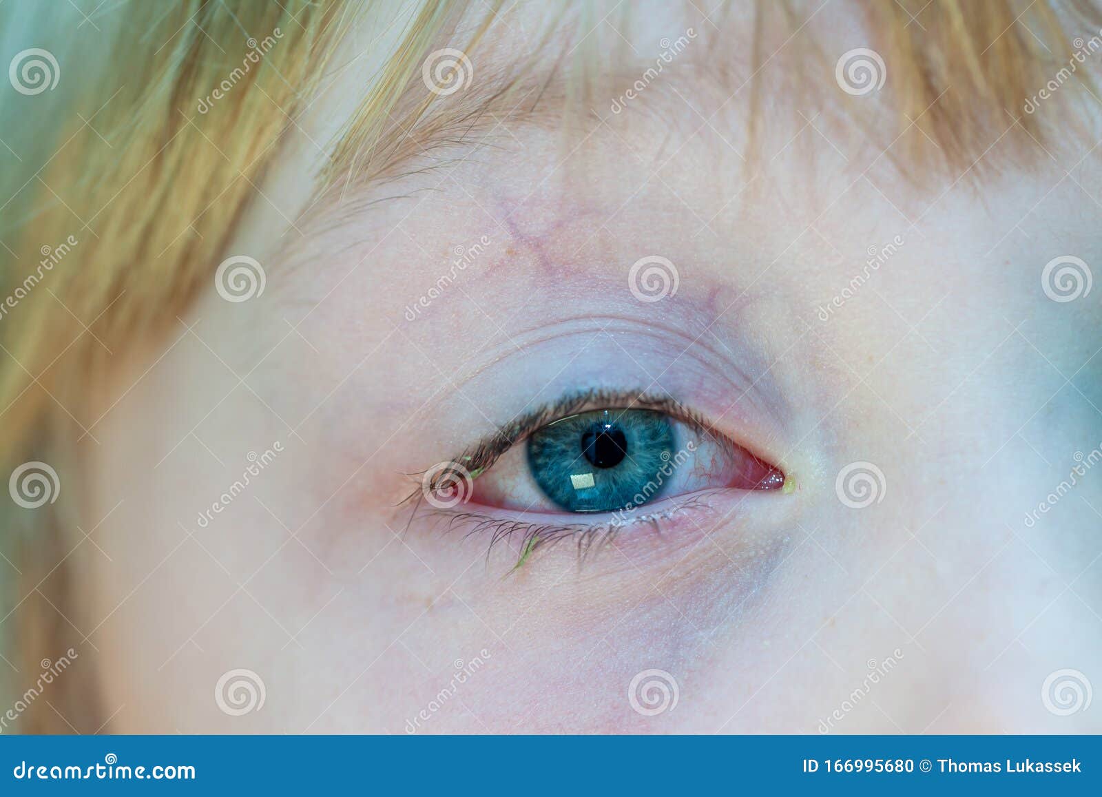 Closeup of Irritated Red Bloodshot Eye Conjunctivitis Stock Photo