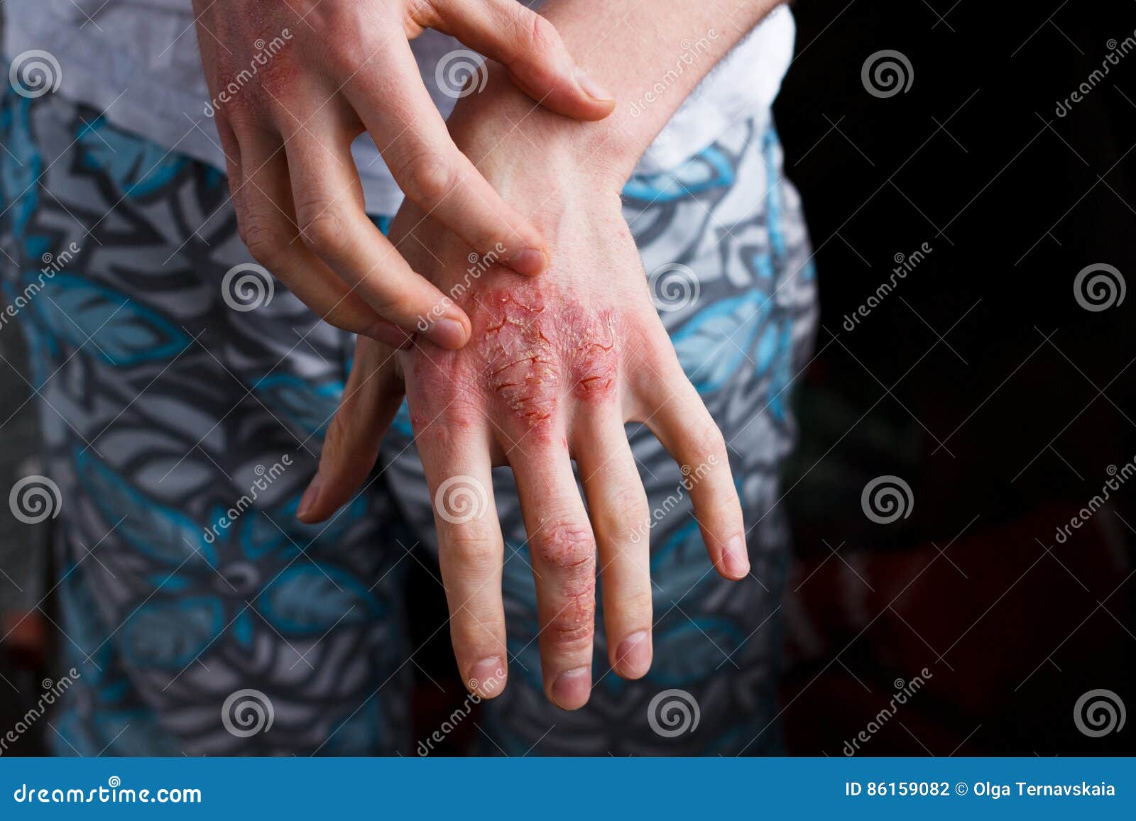 closeup men itching and scratching by hand. psoriasis or eczema on the hand. atopic allergy skin with red spots