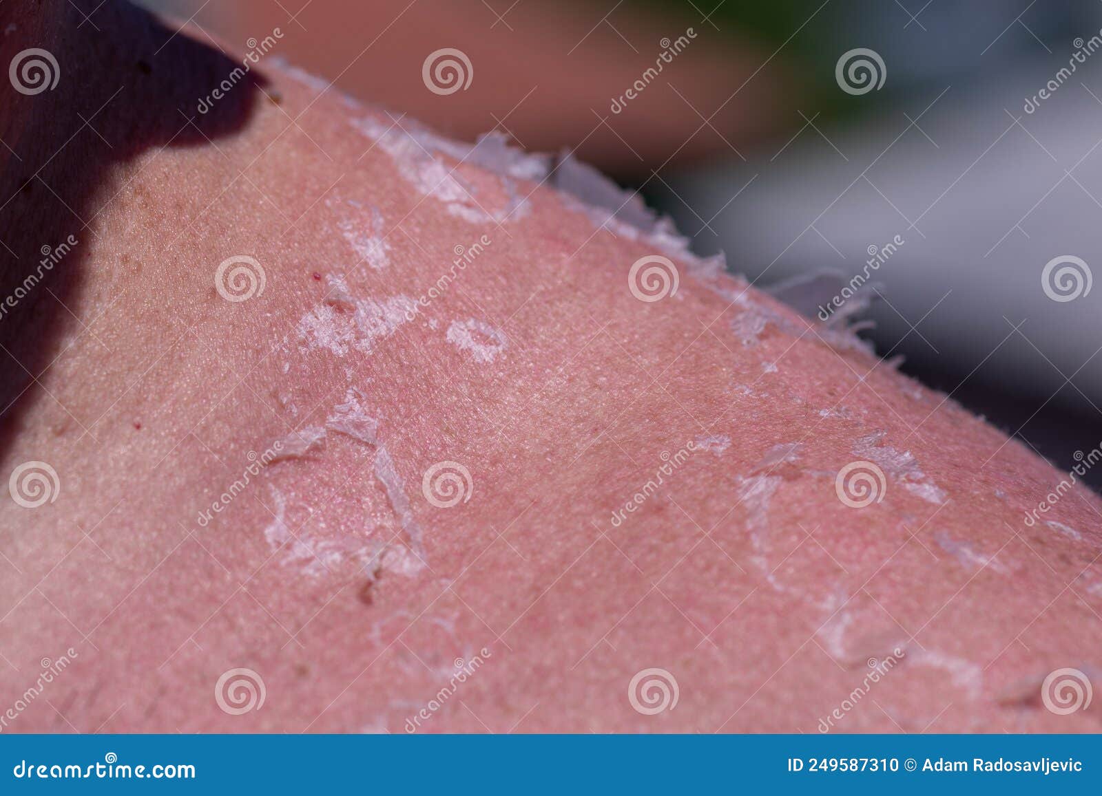 Peeling Sunburned Skin On Back And Shoulder Stock Photo Image Of