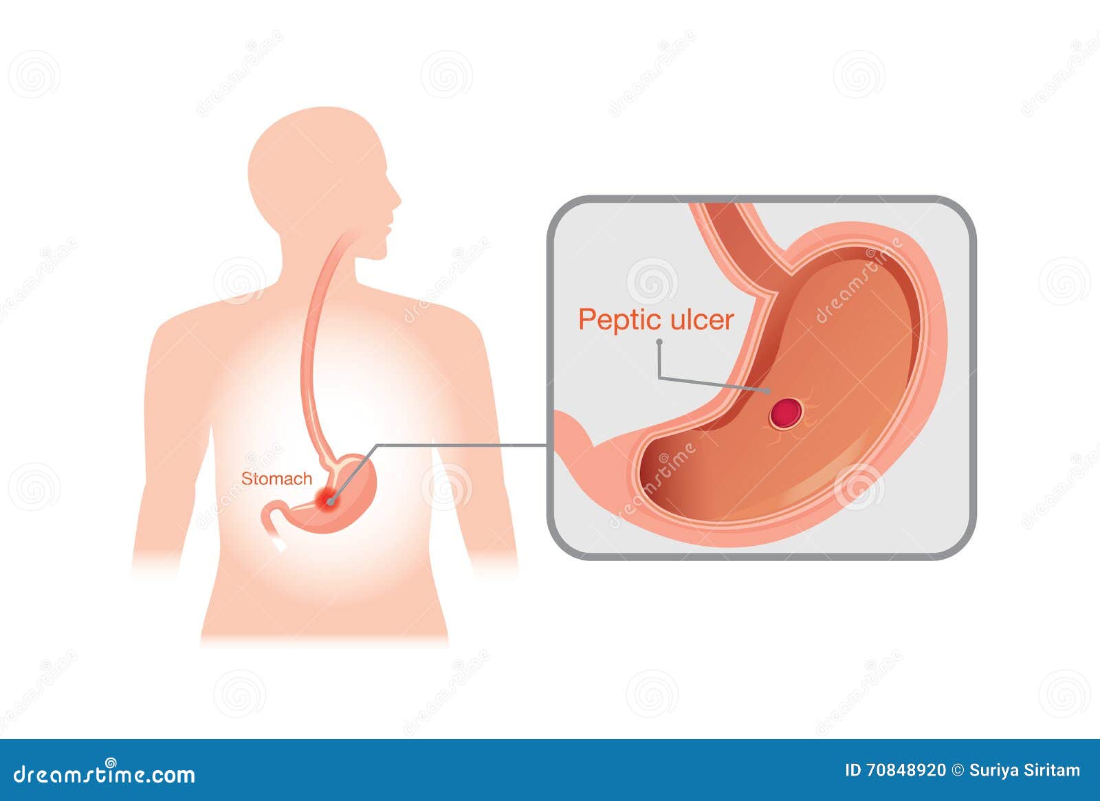 closeup picture of peptic ulcer