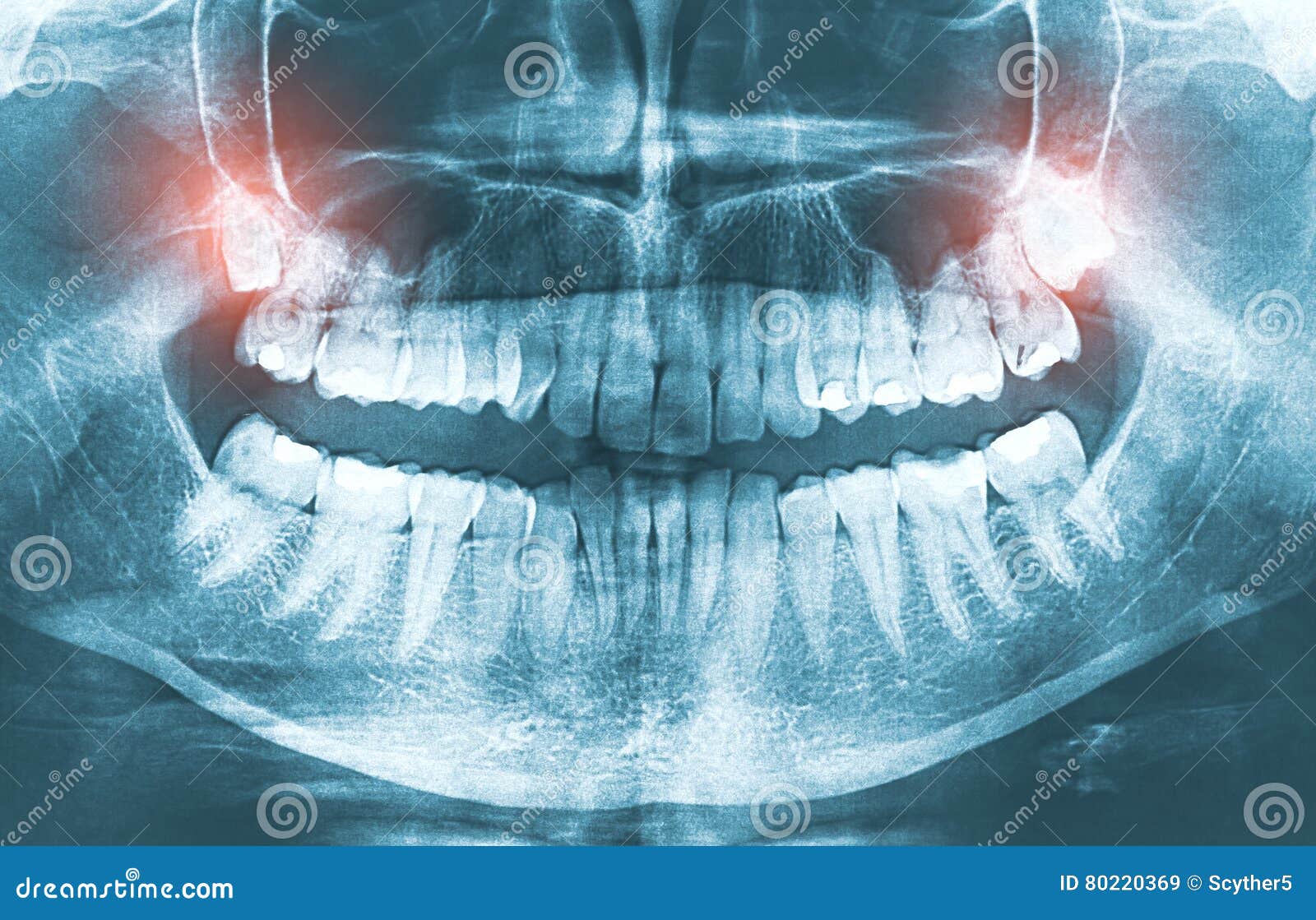 Closeup Of X Ray Image Growing Wisdom Teeth Pain Concept Stock