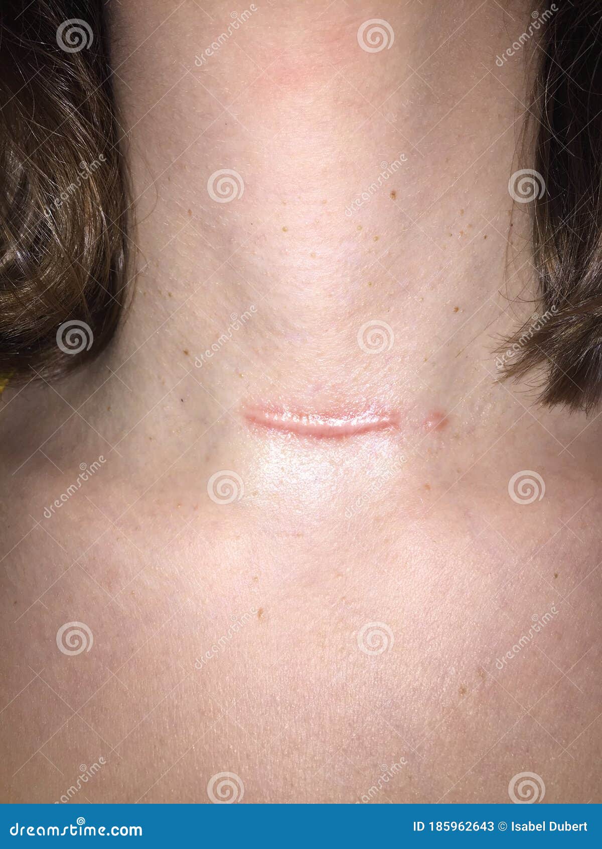 Raised Scar Scar After Appendectomy Cyanotic Keloid Scar Caused By