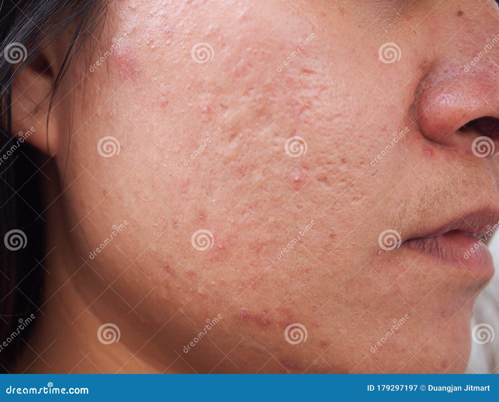 closeup scar acne