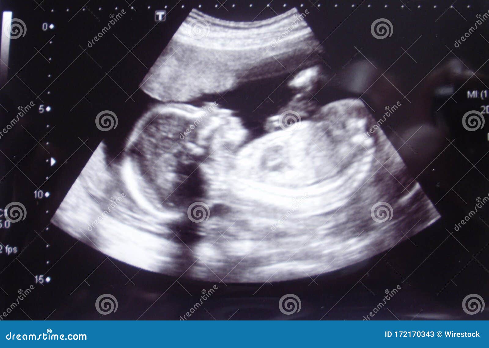 closeup shot of an obstetric ultrasonography