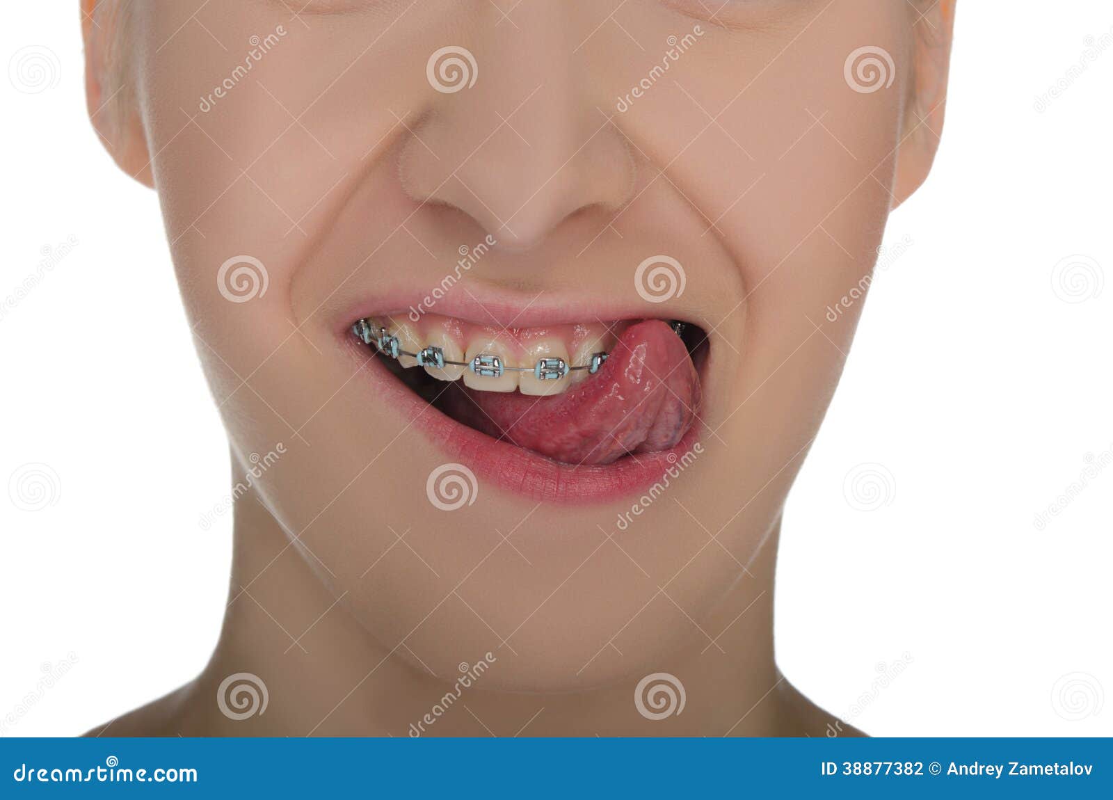 Closeup of Smiling Mouth with Braces Stock Photo Image of teen, mouth
