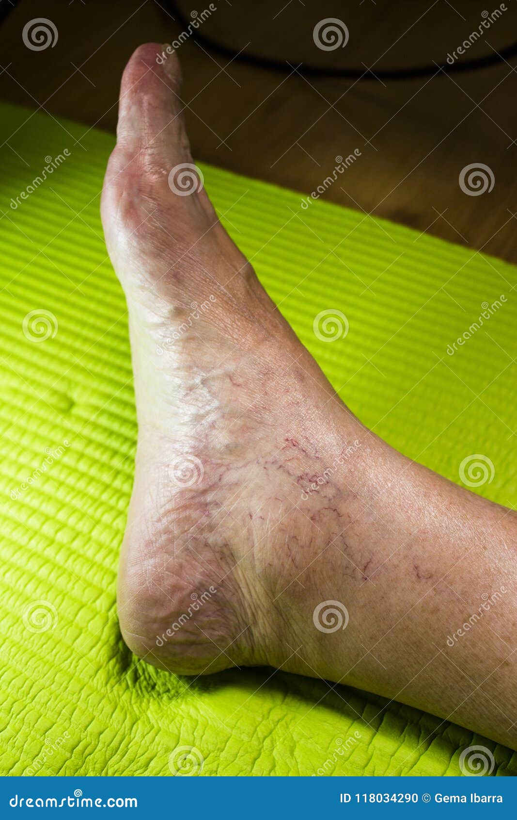 varicose foot woman fotografii)