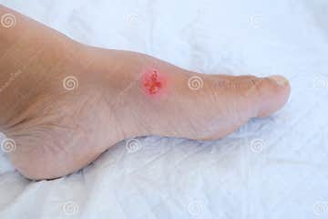 Closeup of Weeping Wound, Thermal Burn, Trophic Ulcer on Female Leg