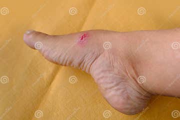 Closeup of Weeping Wound, Trophic Ulcer on Female Leg, Wound Exudate