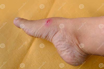Closeup of Weeping Wound, Trophic Ulcer on Female Leg, Wound Exudate