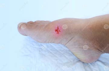 Closeup of Weeping Wound, Trophic Ulcer on Female Leg, Wound Exudate