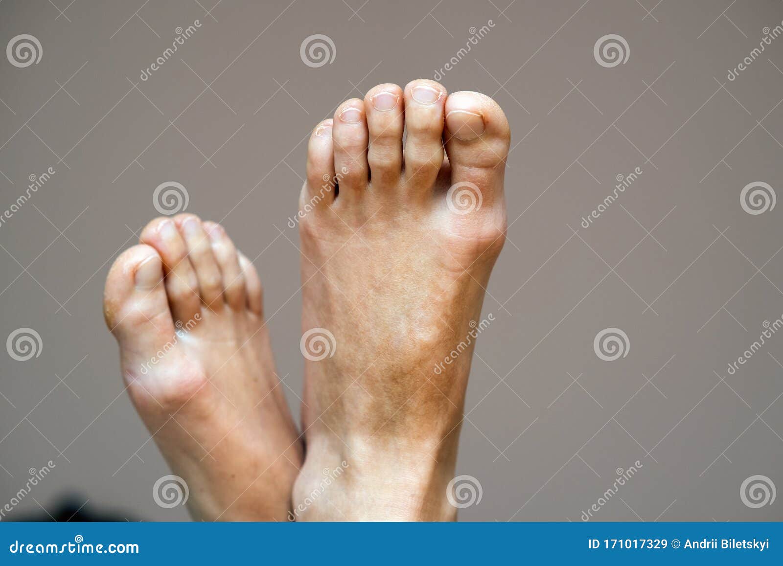 dry feet and toes