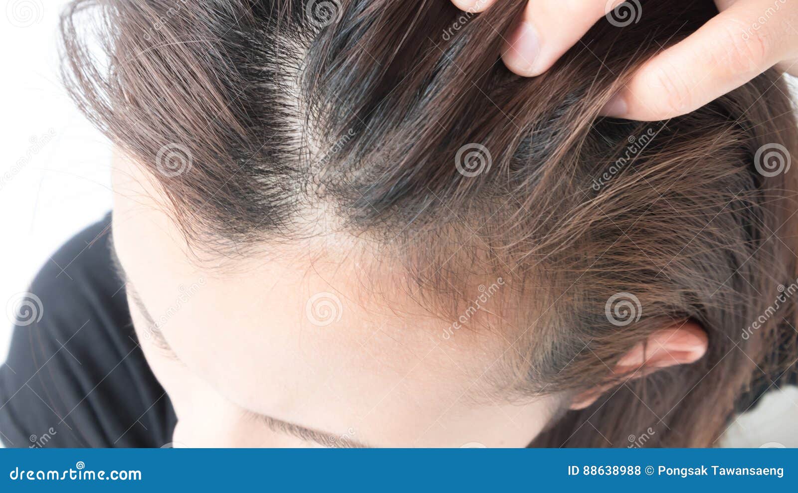 itchy scalp hair loss