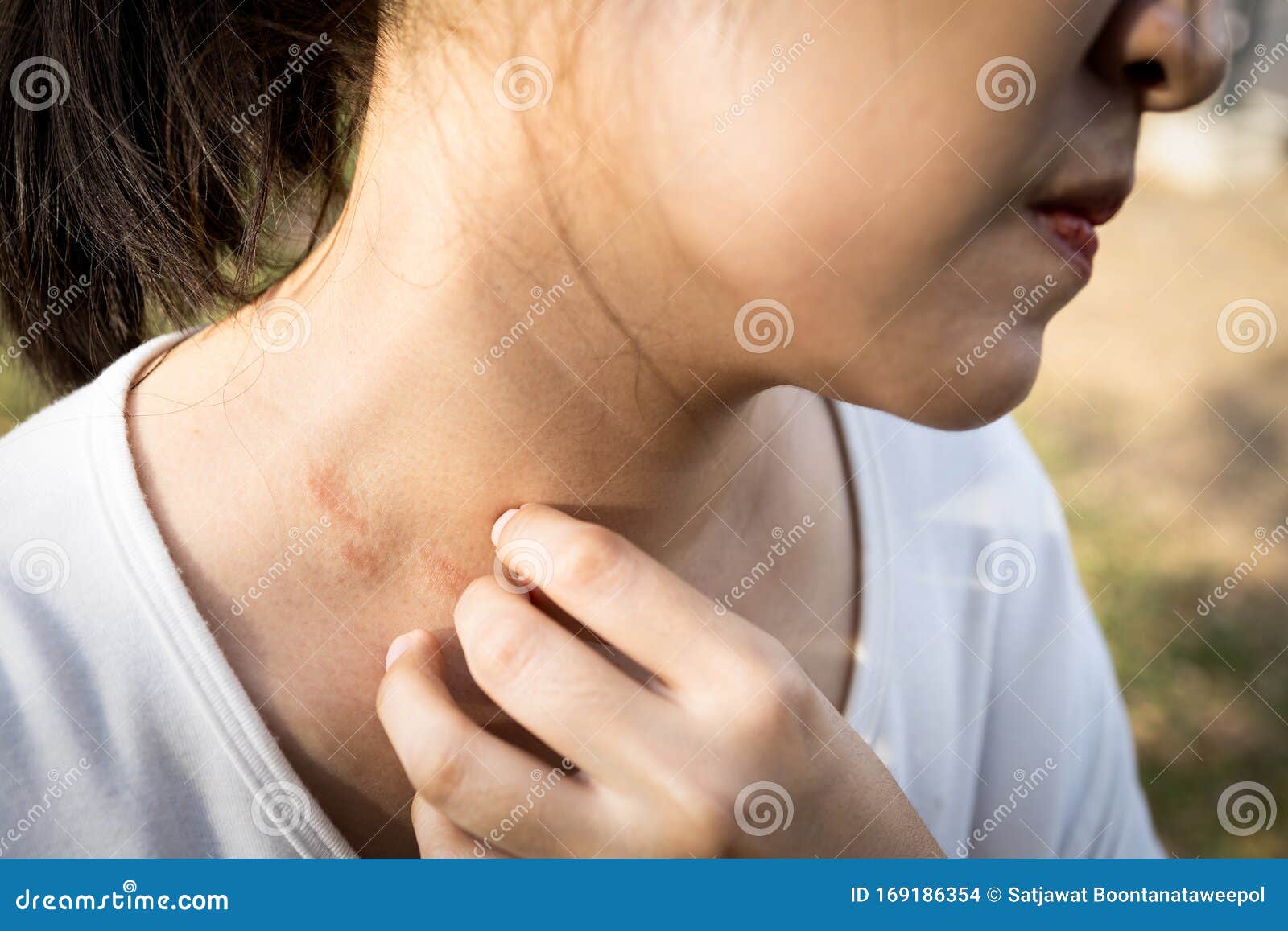 Closeup Woman Hand Scratching Skin Itchy Because Of Allergyallergic