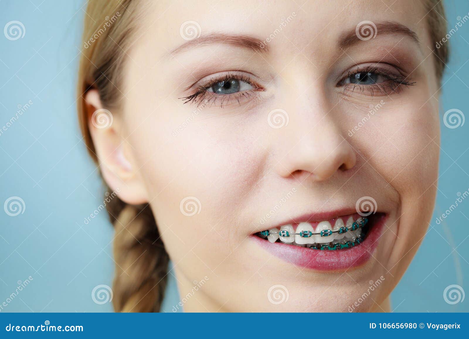 Closeup of Woman Teeth with Braces, Funny Face Stock Photo - Image of ...