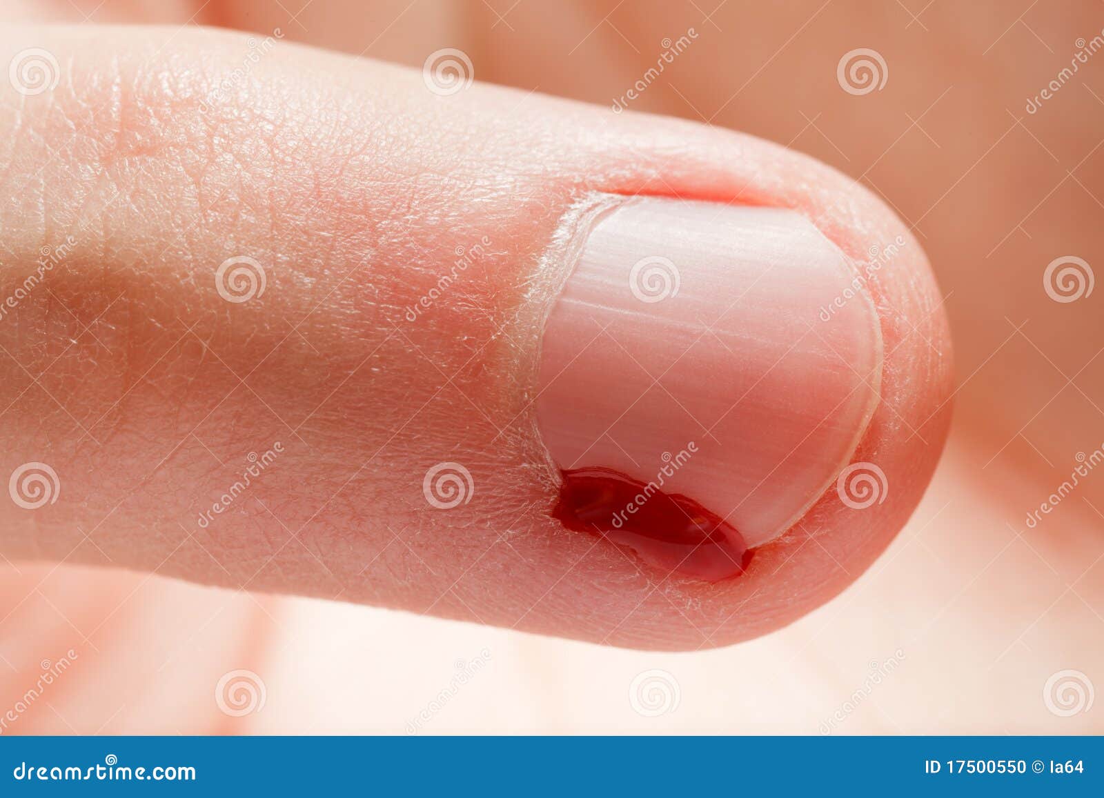 Clou De Doigt De Blessure De Sang Photo stock Image du isolement