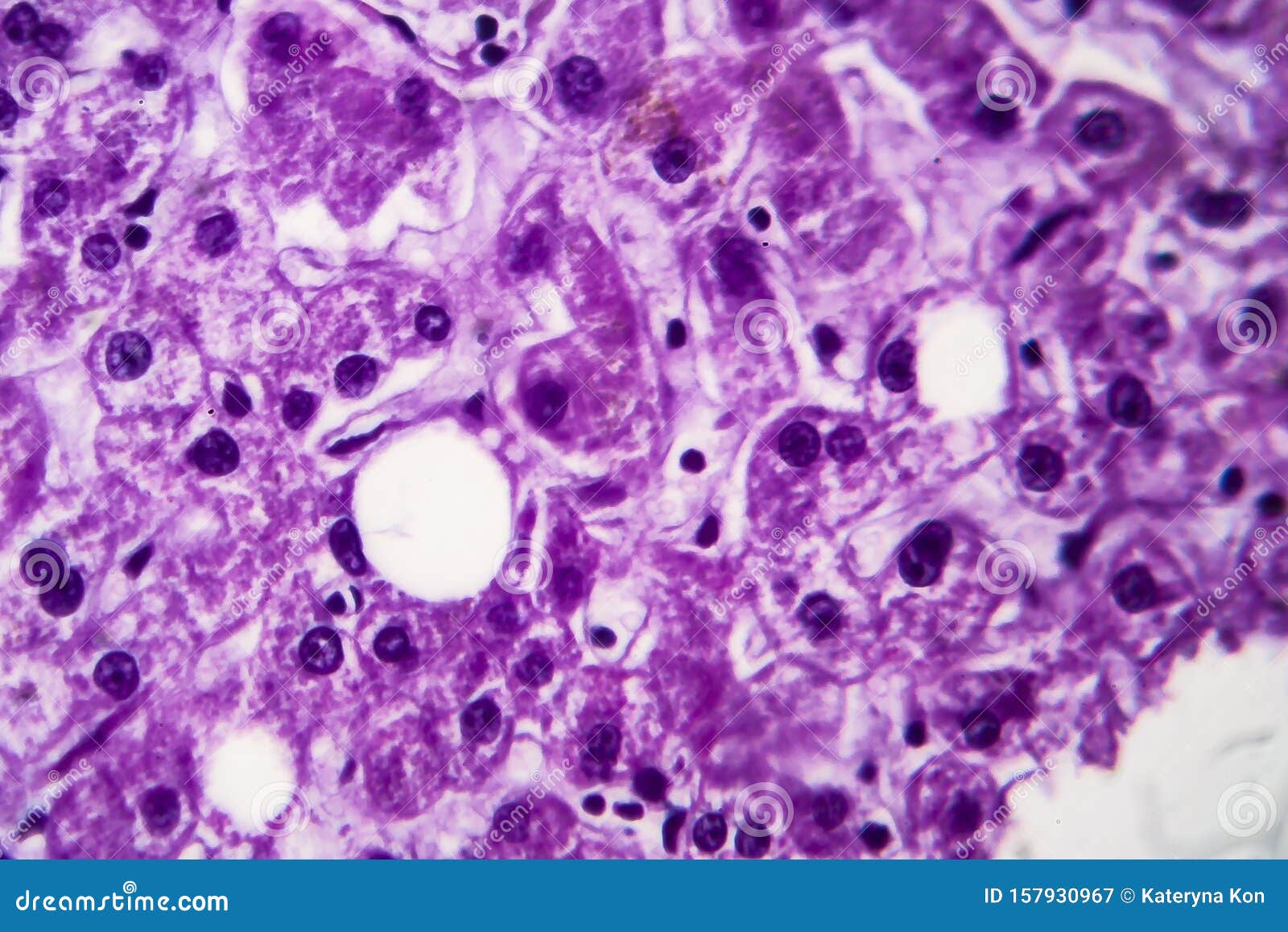 Cloudy Swelling of the Liver, Light Micrograph Stock Image Image of