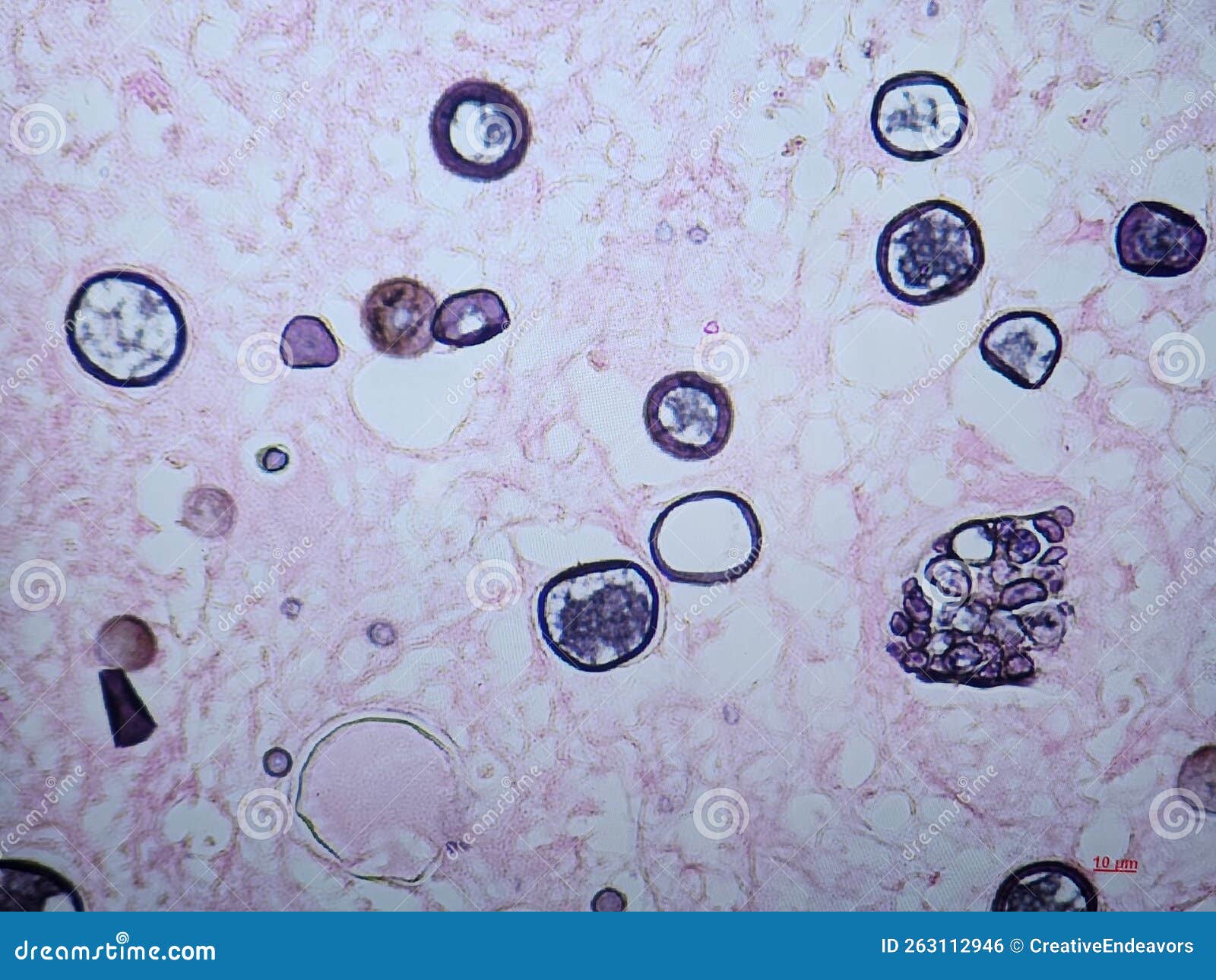 Coccidioides Imitis Spherules and Endospores on GMS Stain Stock Photo