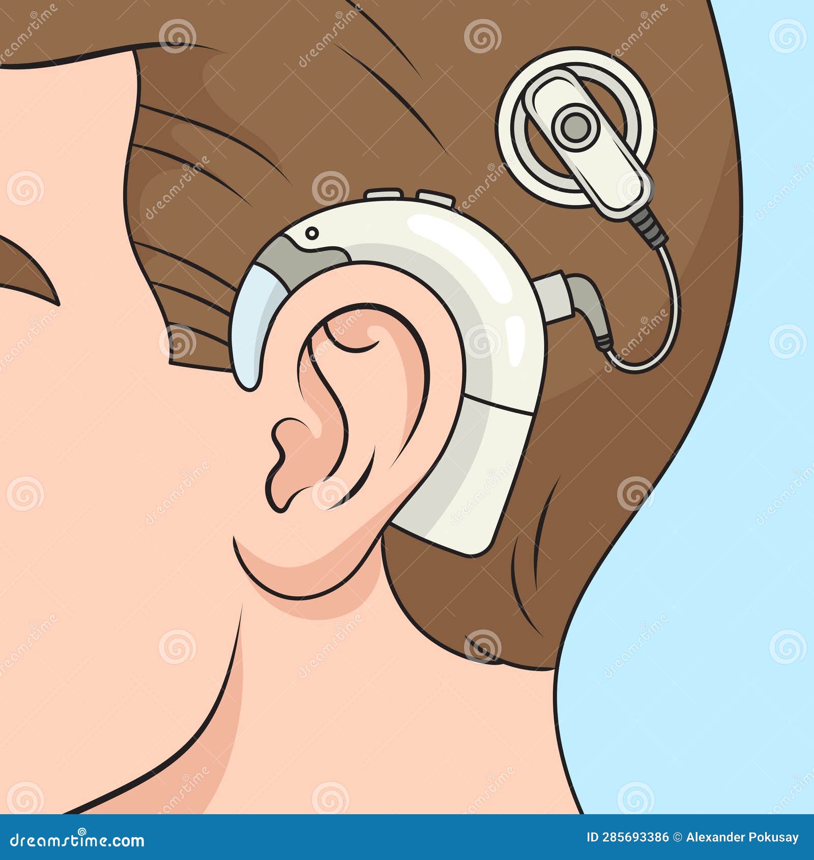 cochlear implant diagram medical science