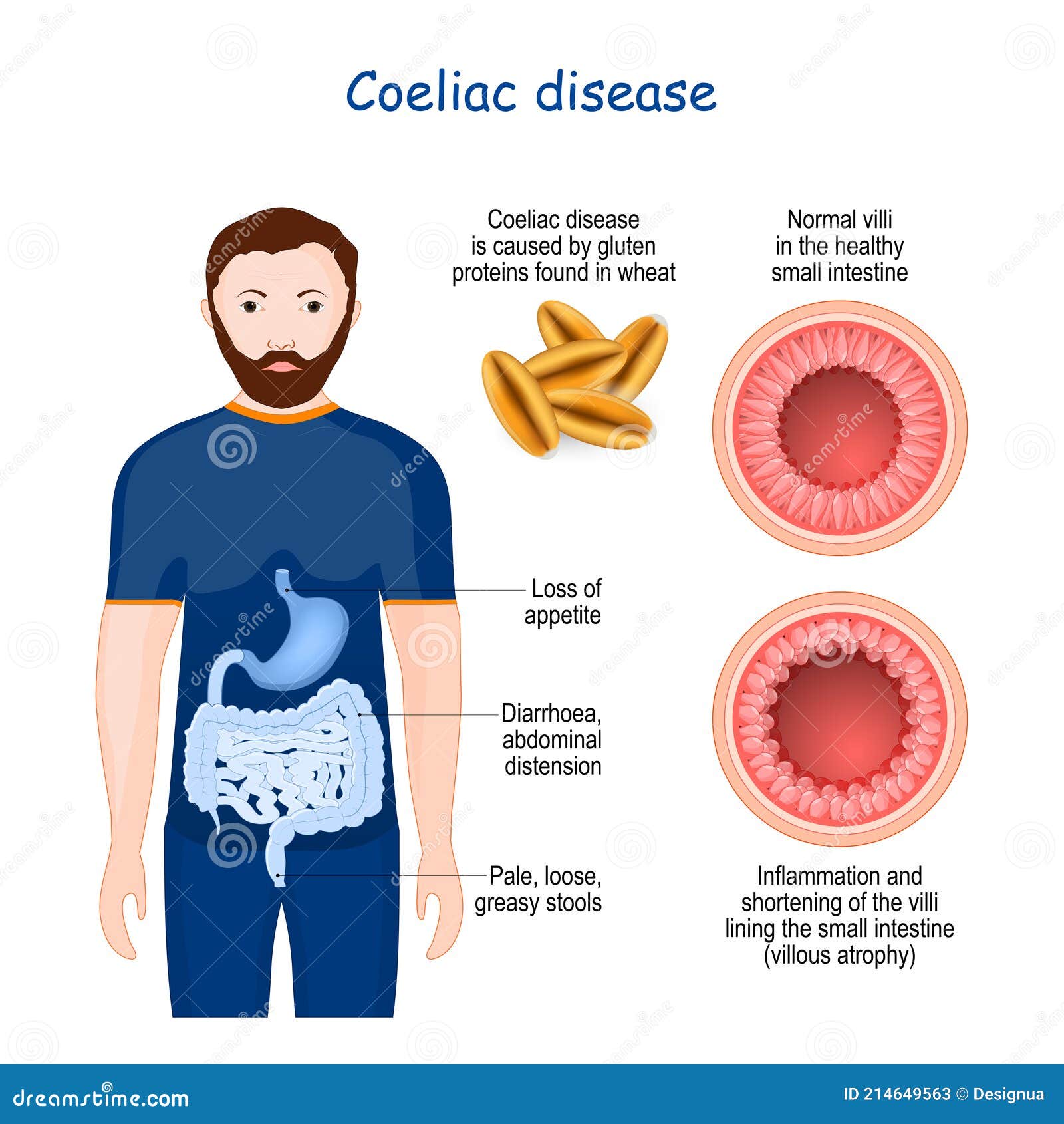 Celiac Or Coeliac Disease Leaky Gut Cartoon Vector CartoonDealer celiac-or-coeliac-disease-leaky-gut-cartoon-vector-cartoondealer
