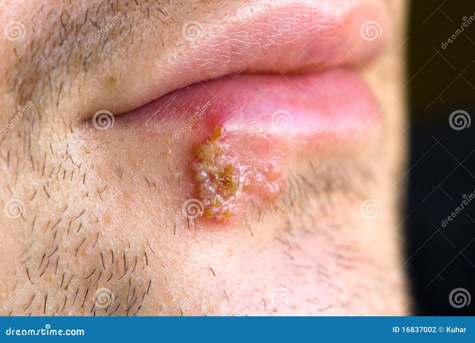 cold sores (herpes labialis)