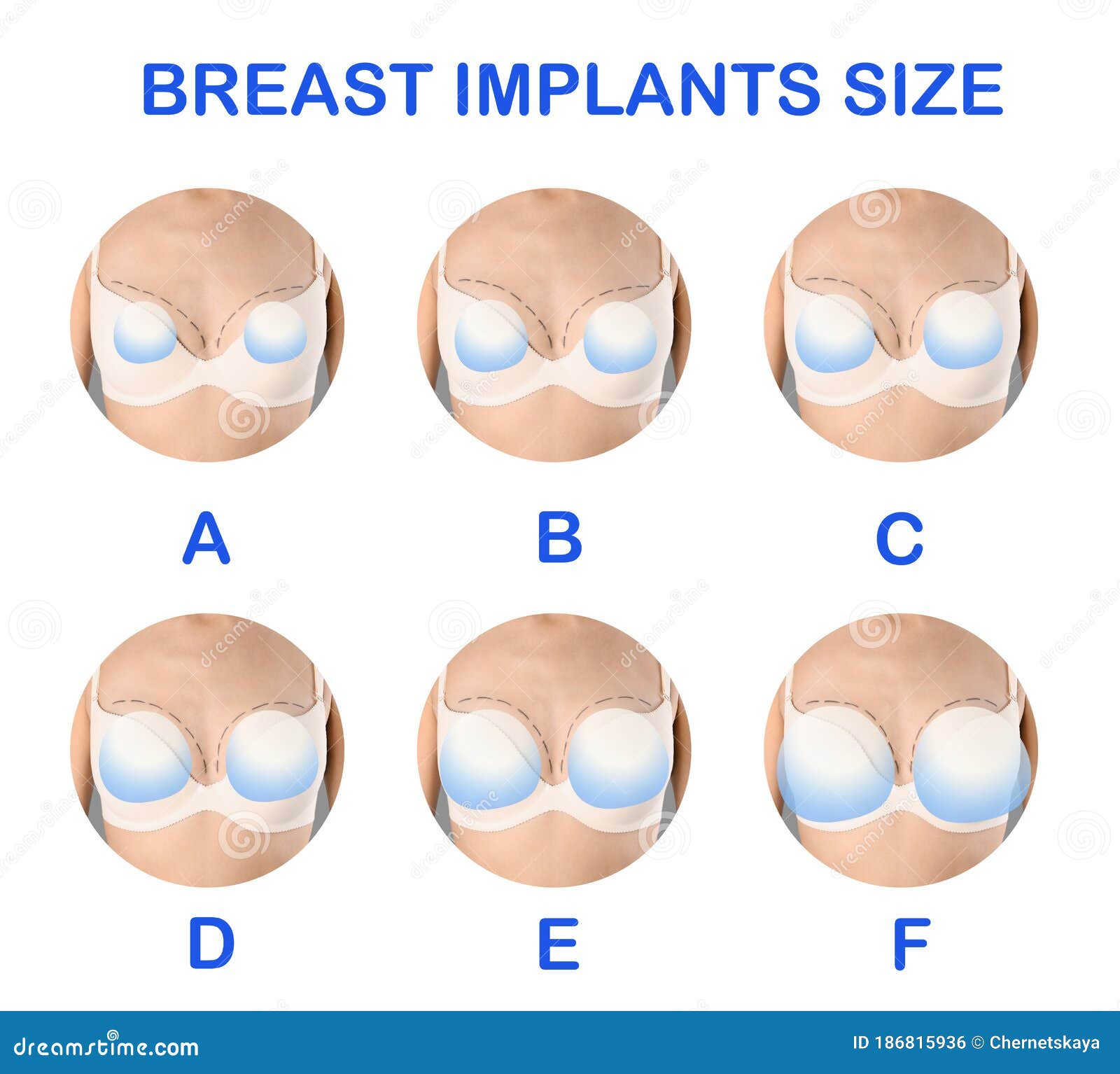 Collage with Photos of Woman Demonstrating Implant Sizes for