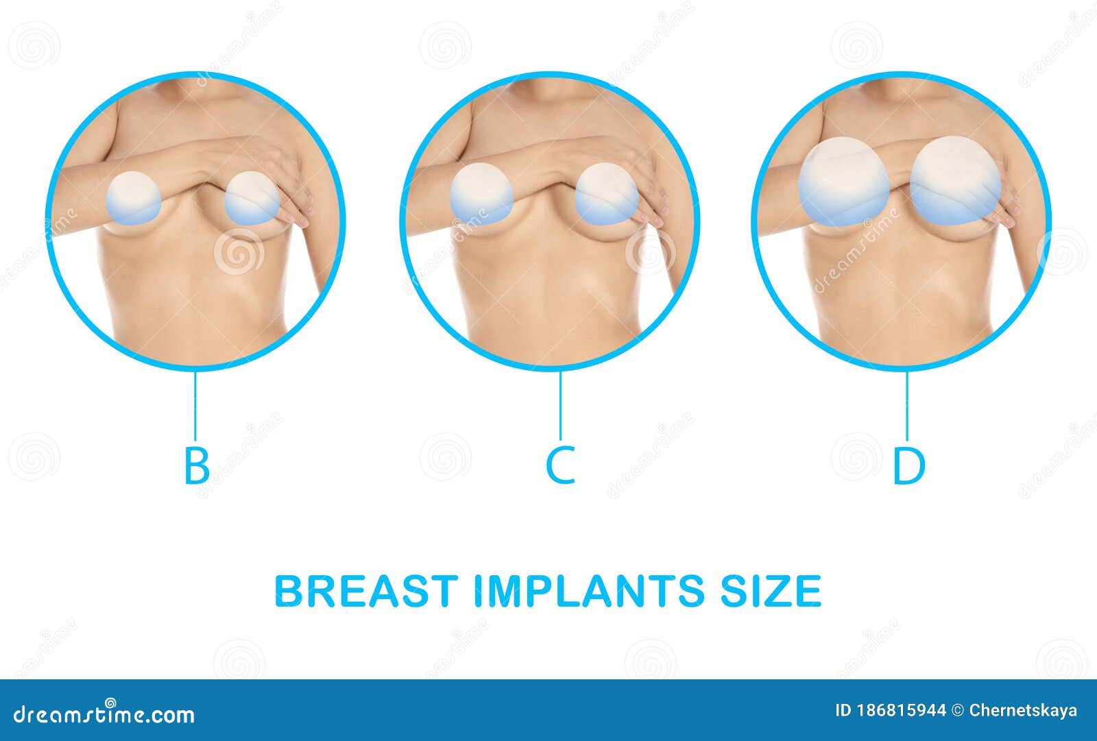 Collage with Photos of Woman Demonstrating Implant Sizes for Breast on  White Background, Closeup. Banner Design Stock Photo - Image of cosmetic,  filler: 186815944