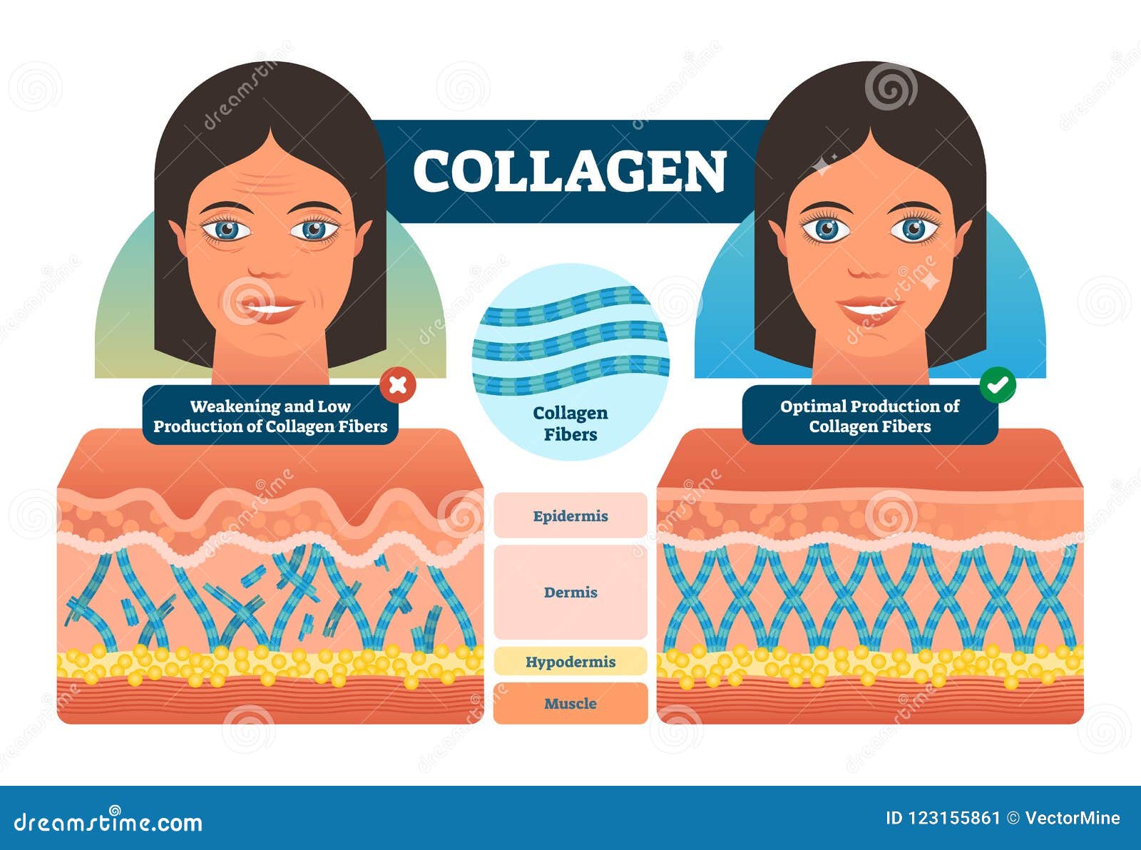 collagen  . medical and anatomical labeled scheme with fibers, epidermis, hypodermis and muscle. anatomy diagram