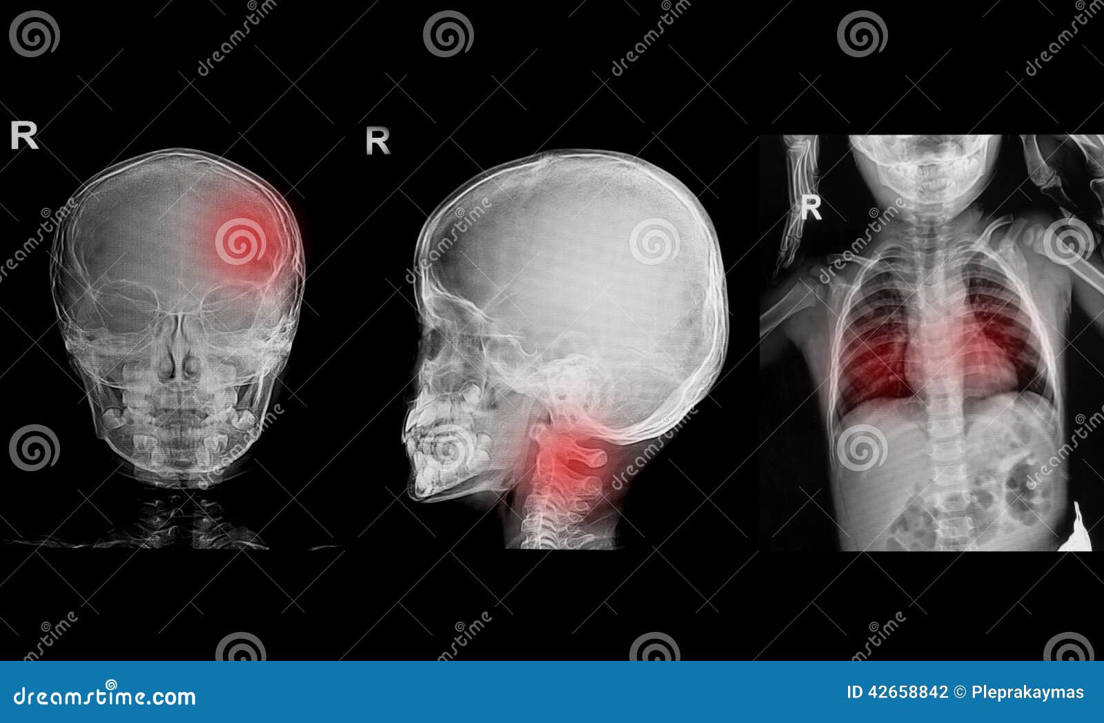 Collection of Children Xrays Stock Photo Image of body, healthcare