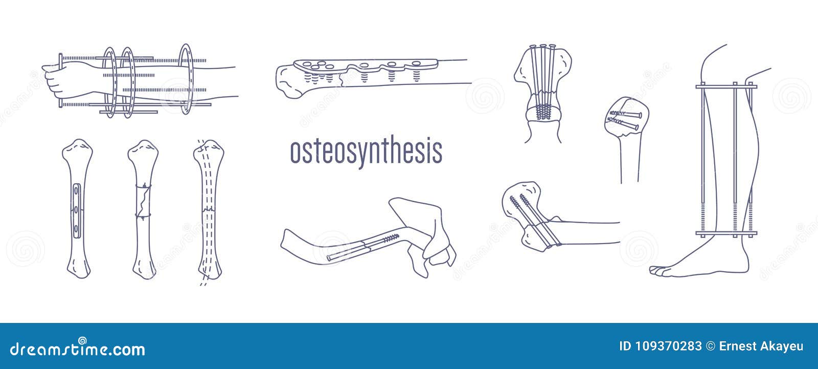 collection of fractured bones and limbs fixed with metal implantable devices drawn with contour lines on white