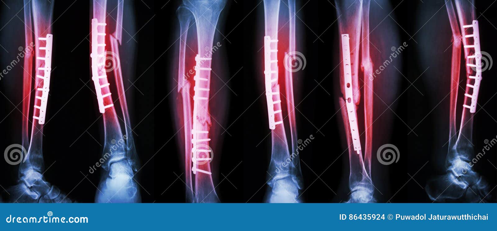 collection image of leg fracture and surgical treatment by internal fixation with plate and . break tibia and fibula bone