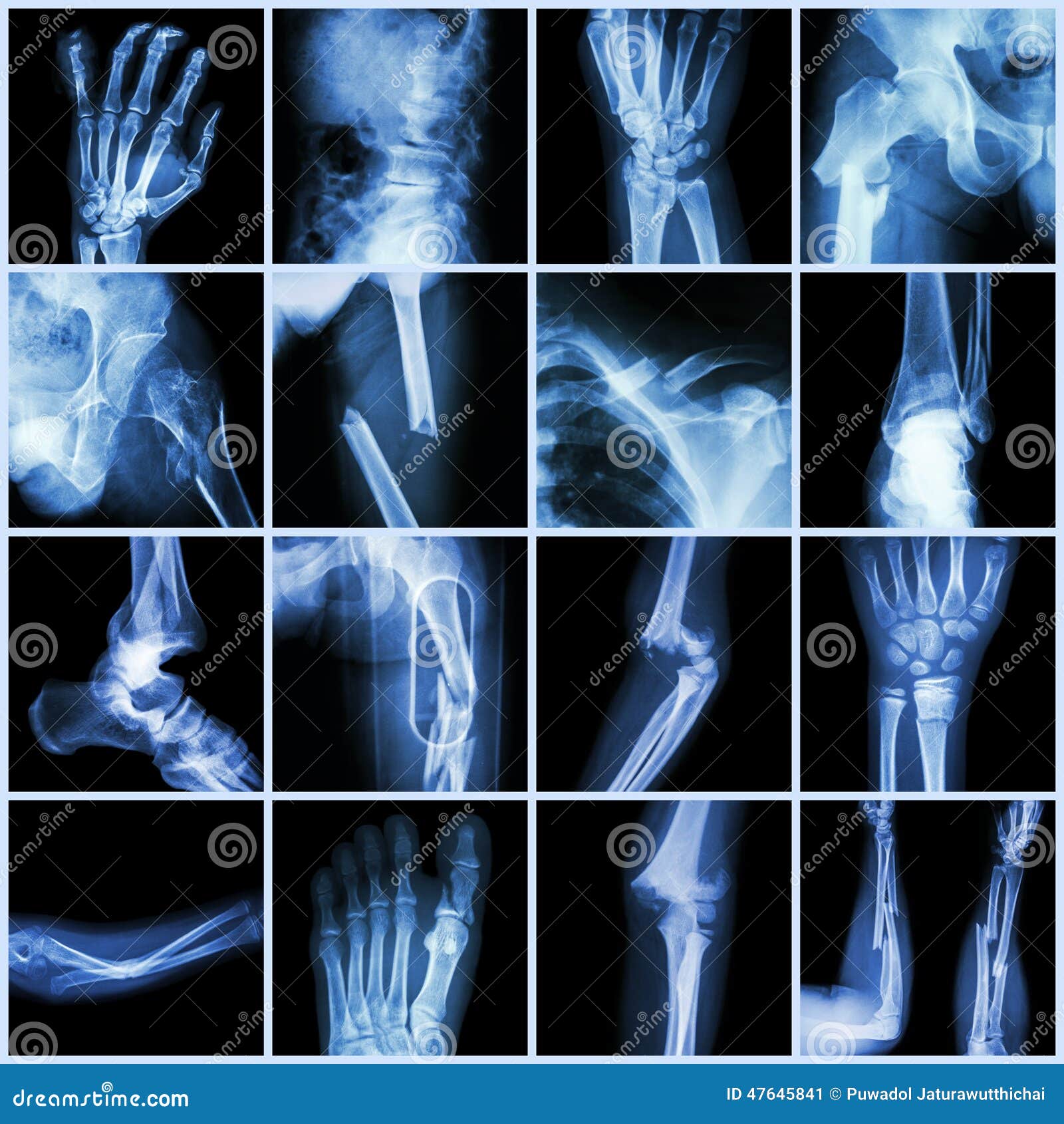 Collection Xray Multiple Bone Fracture Stock Image Image of fracture