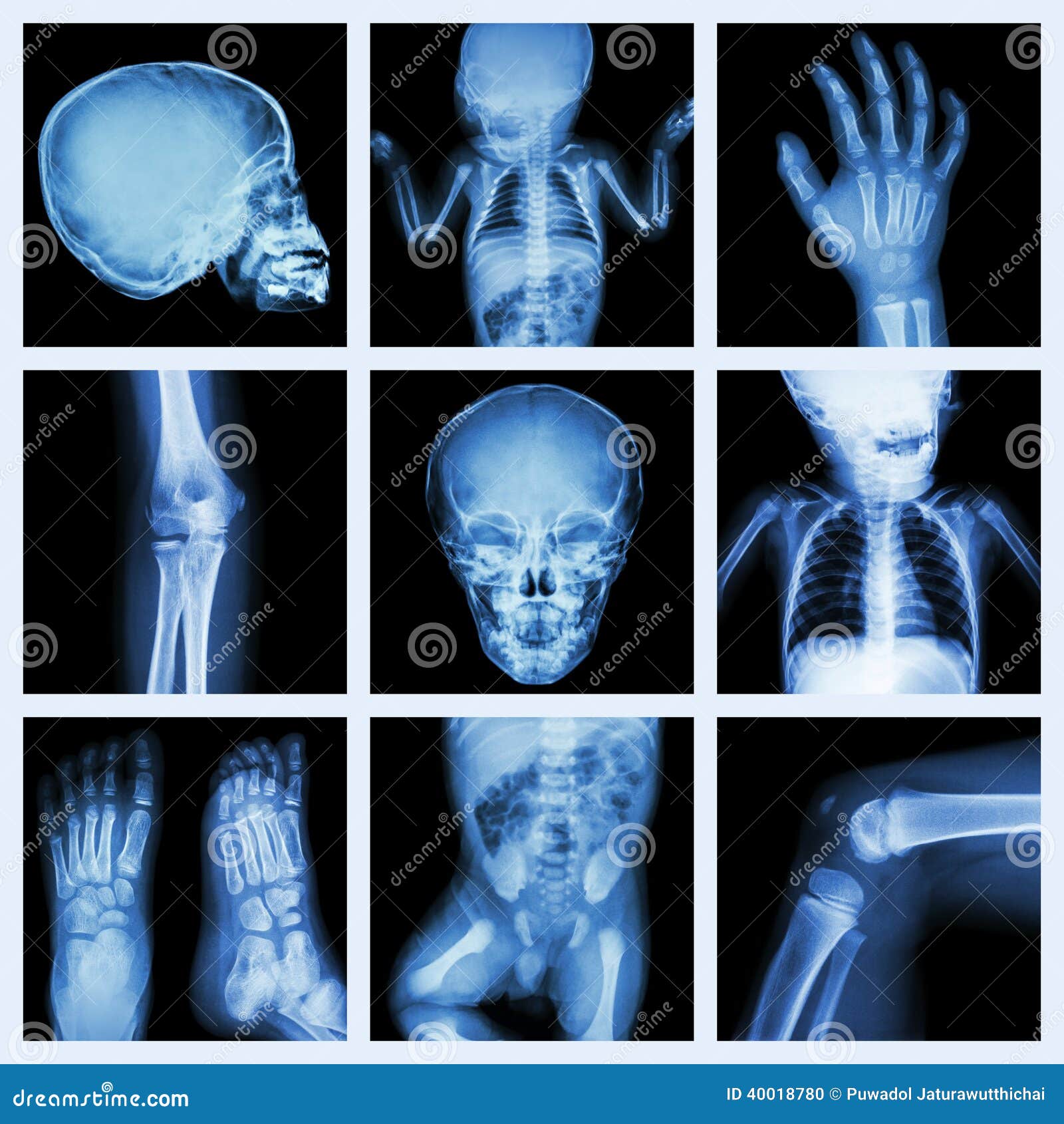 Collection Xray Part of Child Body (Version 2) Stock Photo Image of