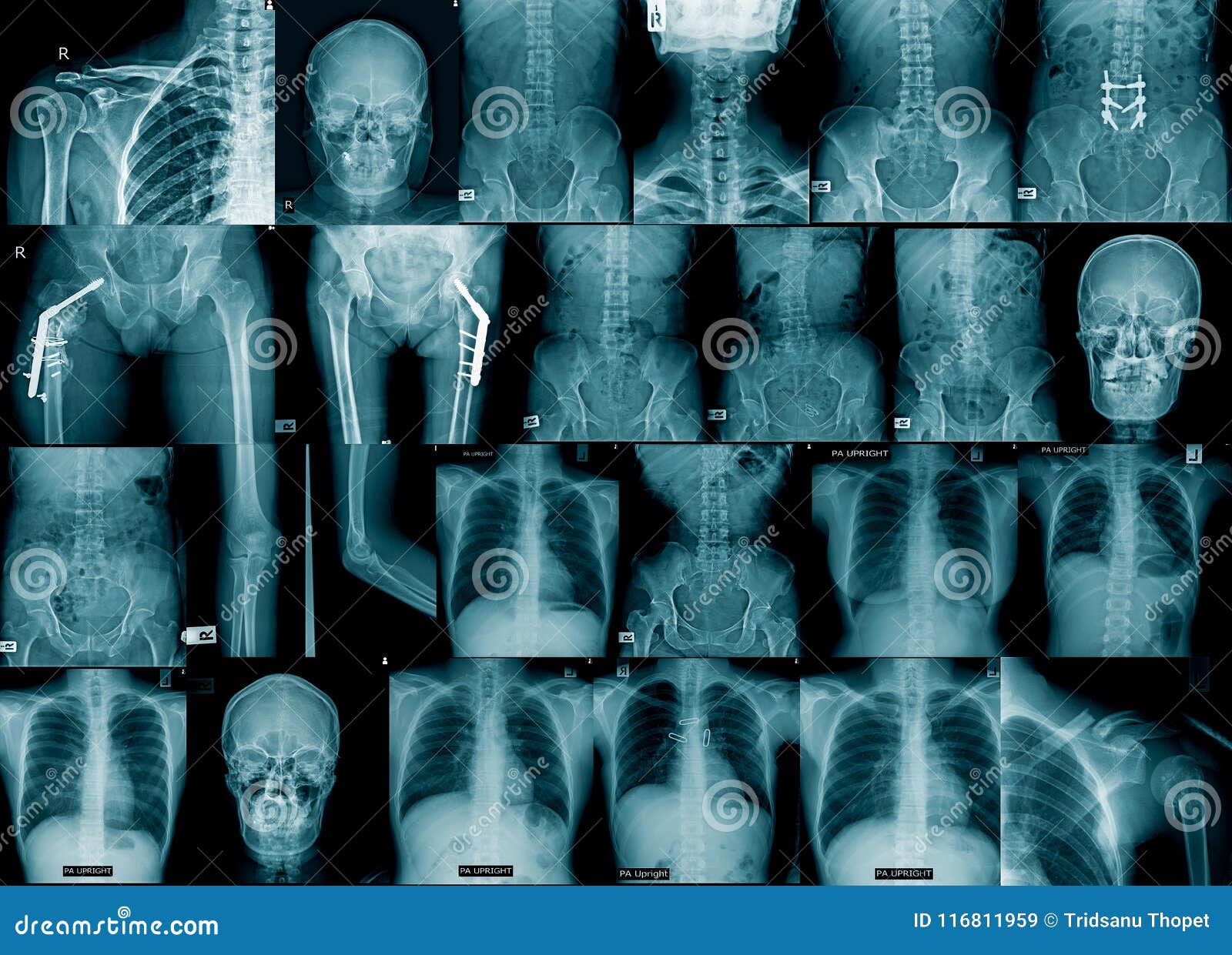 Chest Xray Fracture Right Posterior 6th Rib And Possible Fracture