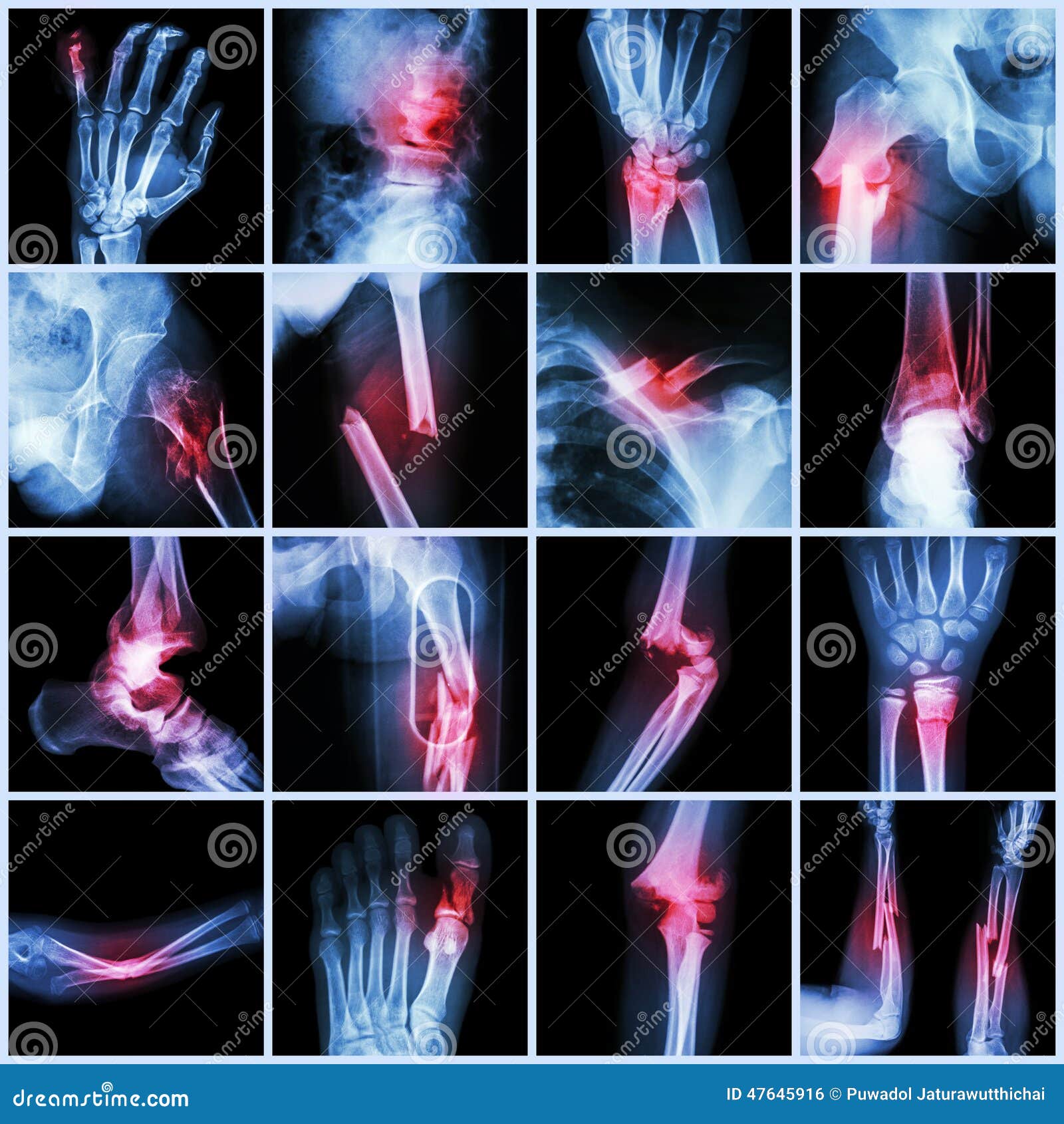 collection x-ray multiple bone fracture