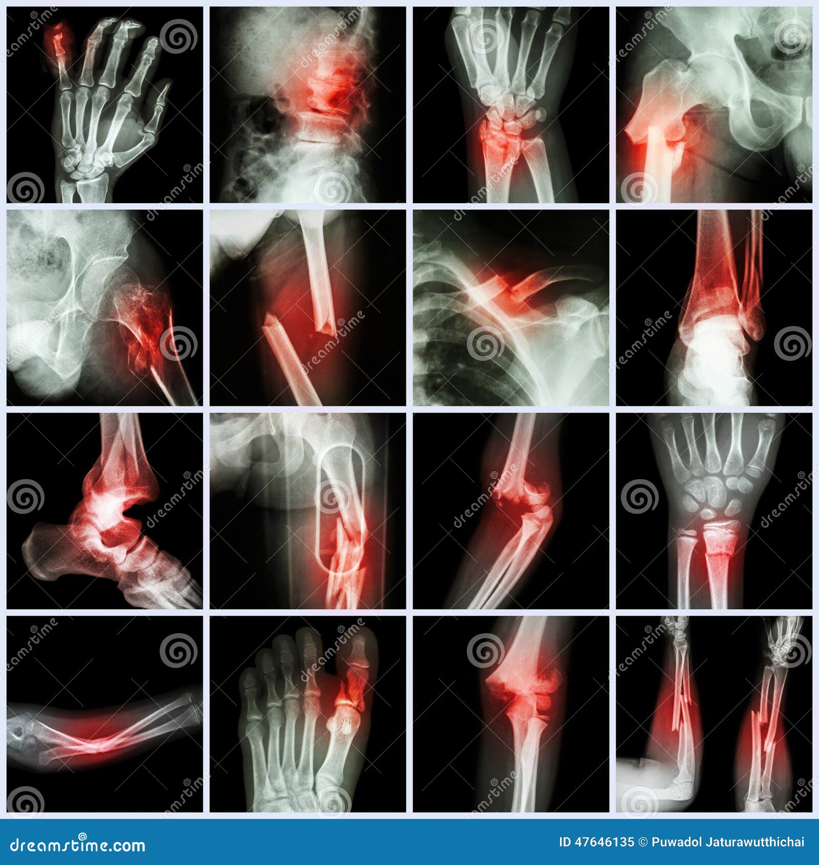 collection x-ray multiple bone fracture