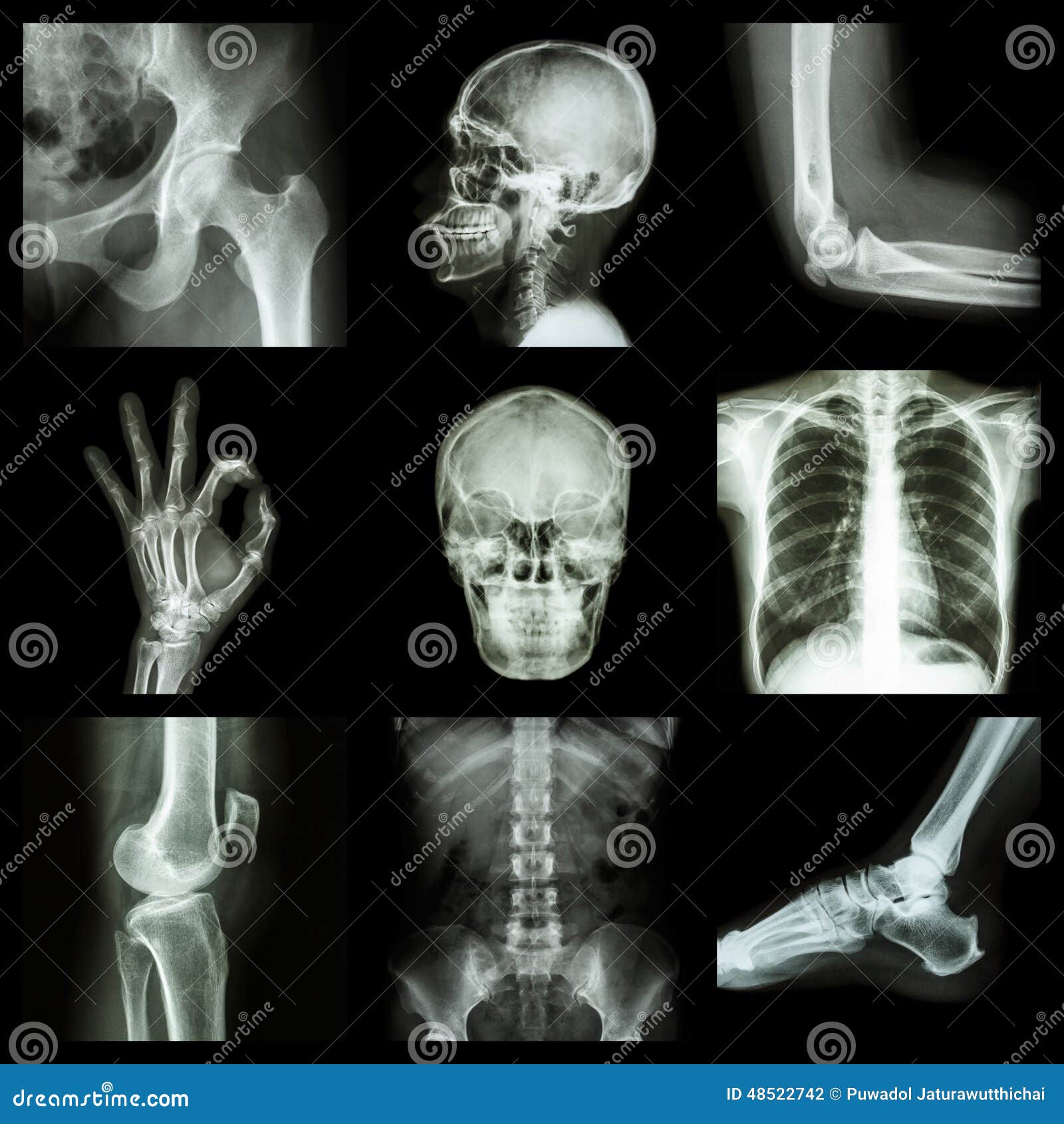 Collection Xray Part Of Human,Orthopedic Operation,Multiple Disease (Fracture,Gout,Rheumatoid
