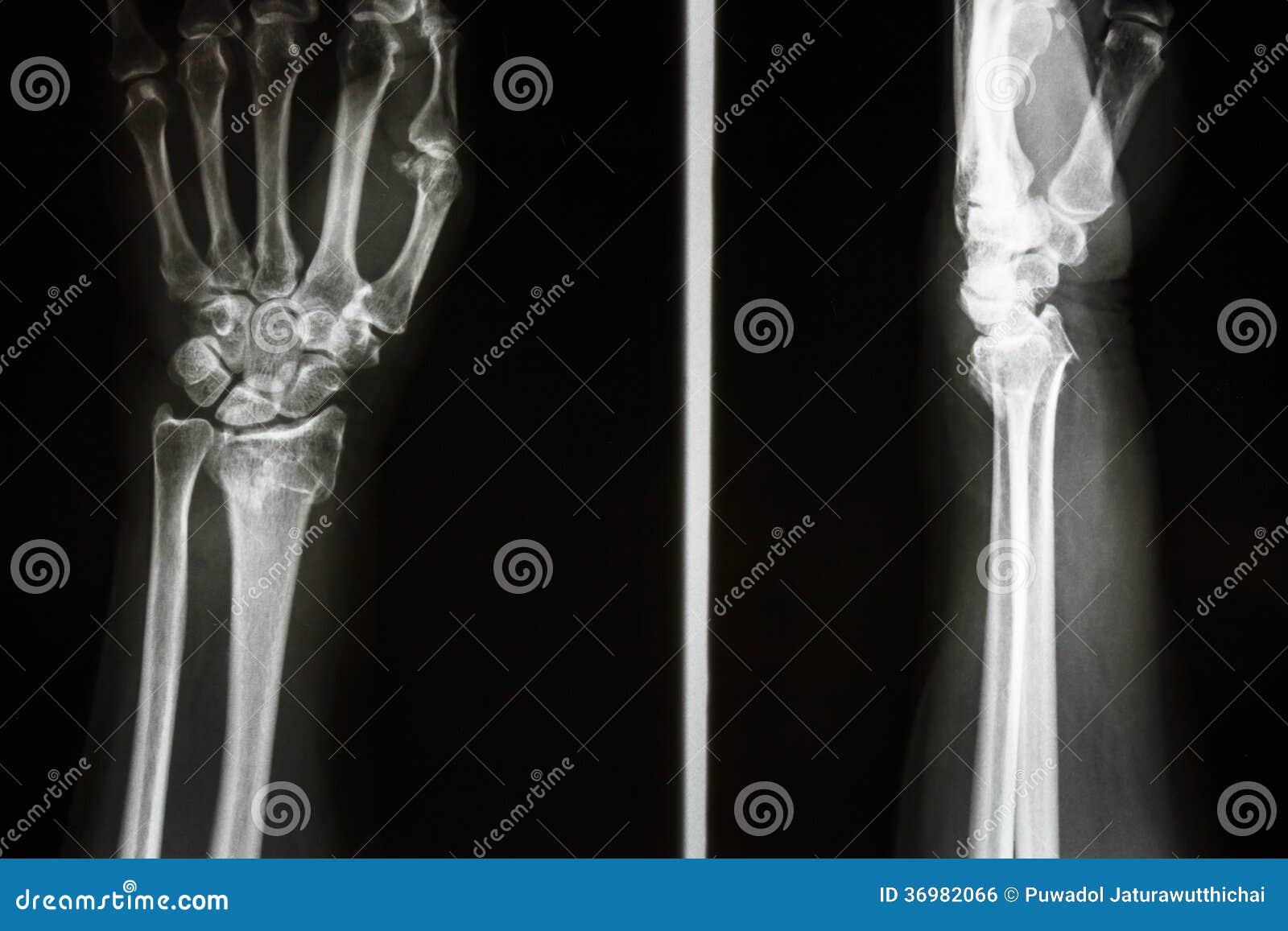colles fracture wrist colles fracture wrist