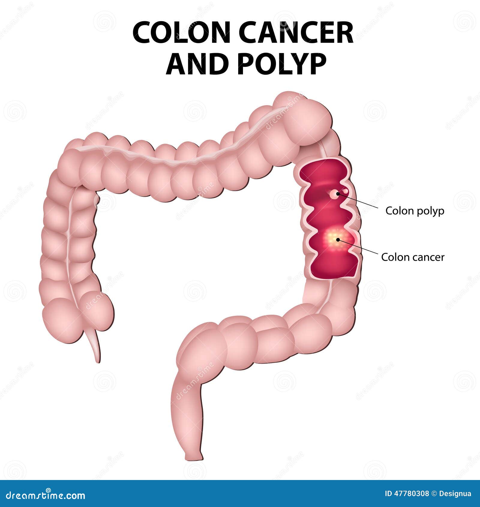 colon cancer and colon polyps